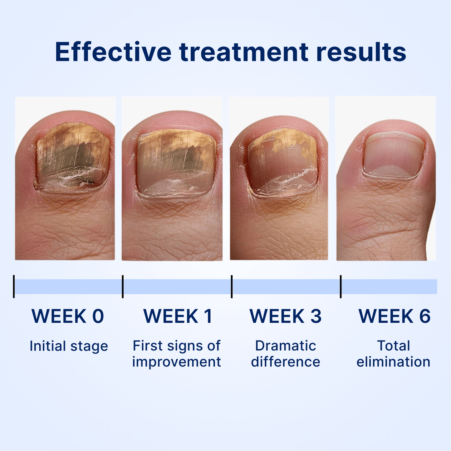 Antifungal nail patches