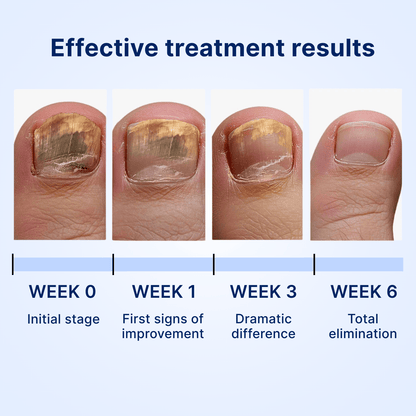 Antifungal nail patches